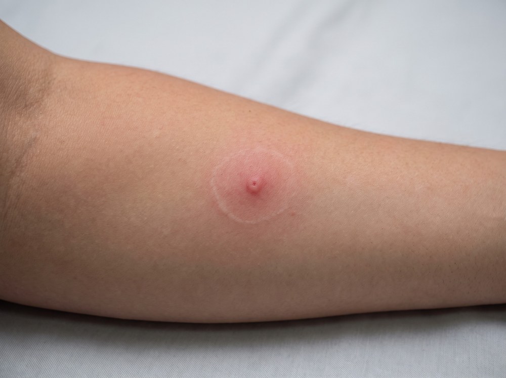 Close-up photograph of an early-stage brown recluse bite showing a small red bump with a central blister